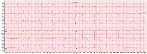 Examples Of Anteroseptal Myocardial Infarction Asmi Ecg Library