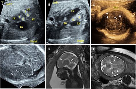 Frontiers Prenatal Diagnosis And Clinical Management Of Cardiac