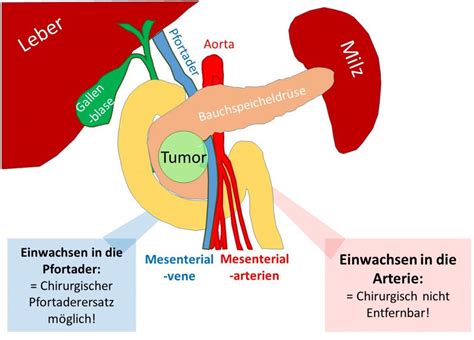 Bauchspeicheldrüsenkrebs Pankreaskarzinom antireflux info