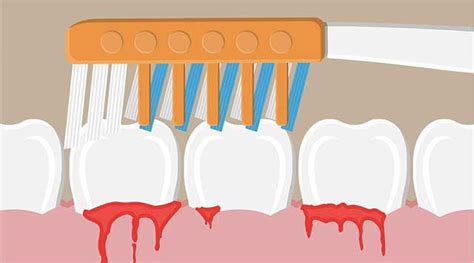 Saignement des gencives Que faire Ma santé bucco dentaire