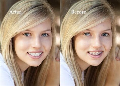 Advantages Of Braces Santa Clarita Ca Invisalign