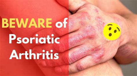 Psoriasis Arthritis Symptoms And Signs Beware Of Psoriatic Arthritis