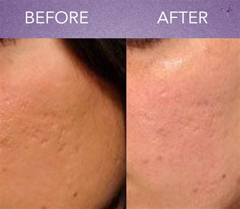 Microneedling Before And After Gallery Dermatologist Choice