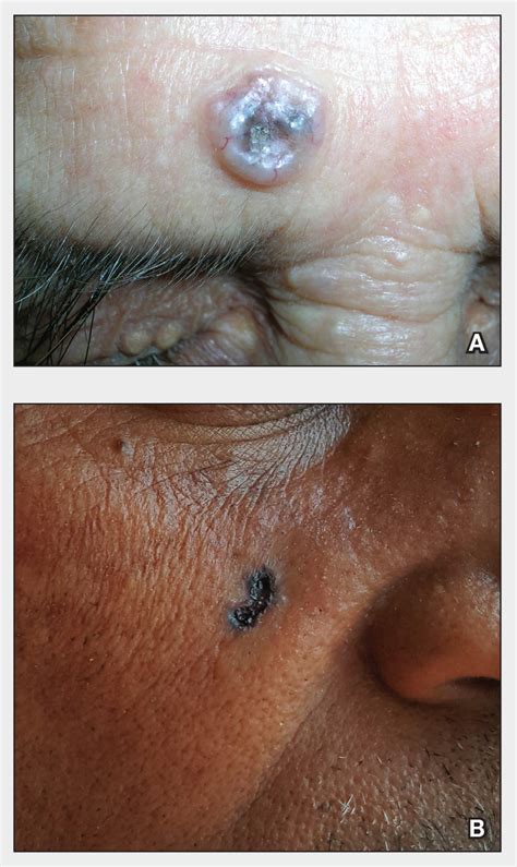 Basal Cell Carcinoma Mdedge Dermatology