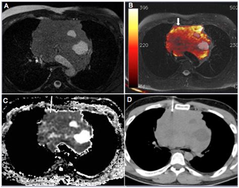 Scielo Brasil Improving Ct Guided Transthoracic Biopsy Of Mediastinal Lesions By Diffusion