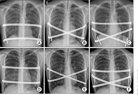 Figure 1 From Technical Advances In Pectus Bar Stabilization In Chest