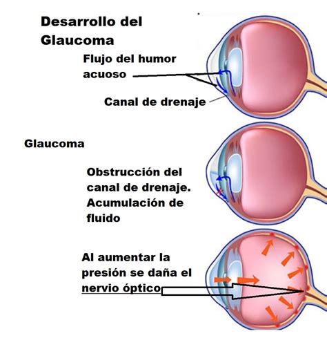 Glaucoma La Ceguera Que No Avisa