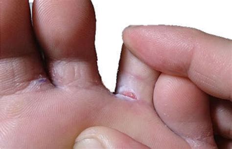 Common Infections On Our Feet Watsonia Podiatry