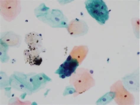 Cytologic Findings Clusters Of Hyperchromatic Crowded Columnar Cells