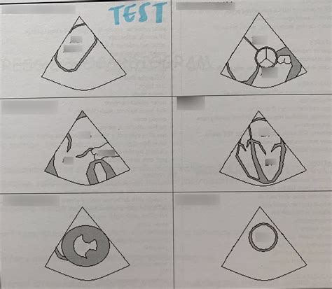 Echo TEE Diagram | Quizlet