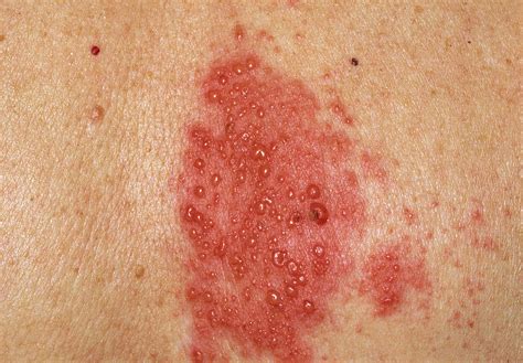 Herpes Zoster Blisters On A Womans Back Photograph By Dr P Marazzi