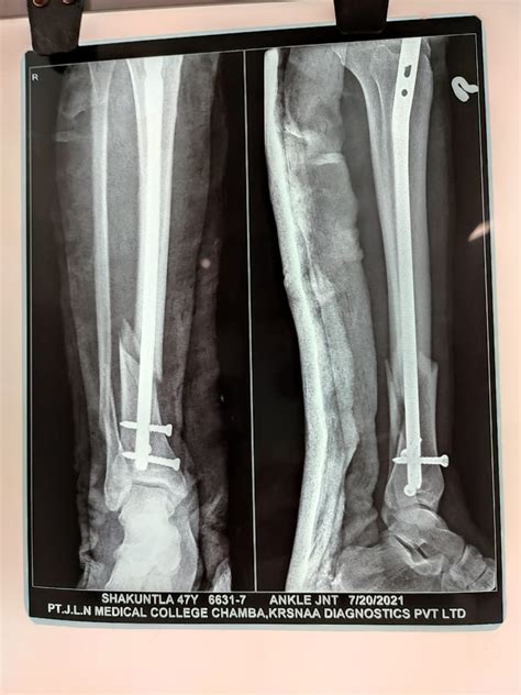 Distal Tibia Fracture Classification