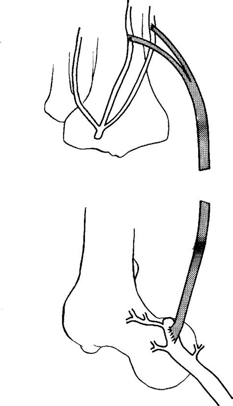 Figure 3 From Double Tibial Artery Bypass Graft Semantic Scholar