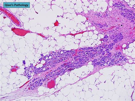 Qiaos Pathology Primary Peritoneal Serous Carcinoma A Photo On