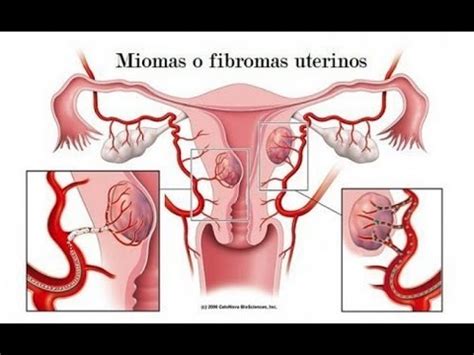 Mioma uterino 5 coisas que você deveria saber sobre mioma no útero