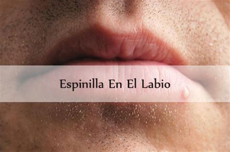 Espinilla En El Labio Causas Y Tratamientos Naturales Efectivos