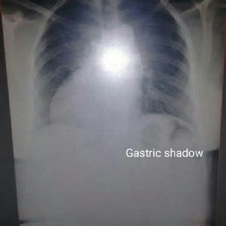 Chest X Ray Pa View Demonstrating Dextrocardia Situs Solitus