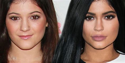 Kylie Jenner Lip Injection