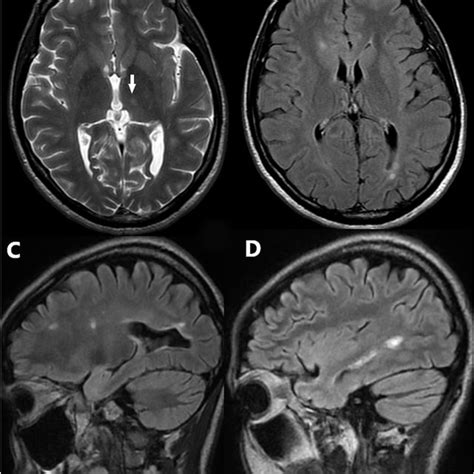 Brain Mri Scans Upon First Admission Axial T2 Scan A Shows A Lesion