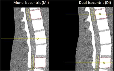 Dosimetric Assessment Of The Mono And Dual Isocentric Vmat Technique