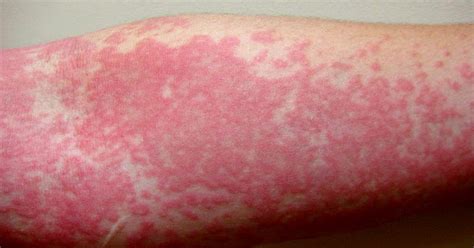 Chronic Idiopathic Urticaria Hives Treatment The Dynamic Natural