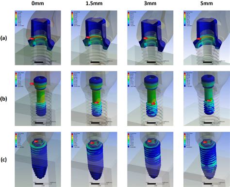 Figure 1 From Effects Of Marginal Bone Loss Progression On Stress Distribution In Different