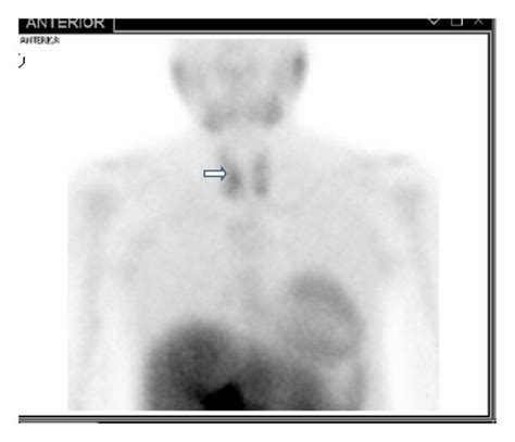 Radionuclide Parathyroid Imaging Using Technetium Tc 99m Sestamibi