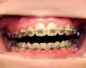 What are Tooth Mamelons? | Ask an Orthodontist.com