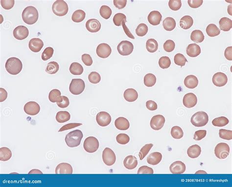 Sickle cell disease. stock image. Image of shape, cell - 280878453