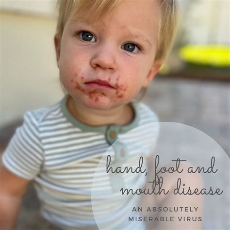 Hand Foot And Mouth Disease What Is It And Treatment Tips — House