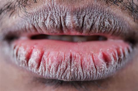 Close Up Of Dry Lip Of A Young Men Stock Photo Image Of Cold Chapped