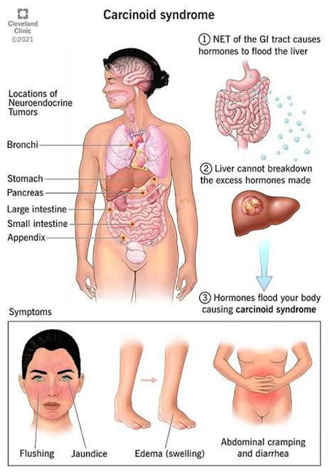 Carcinoid Syndrome Medizzy