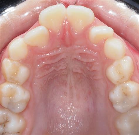 Affollamento Dentale Nei Bambini Come Riconoscerlo E Cosa Comporta