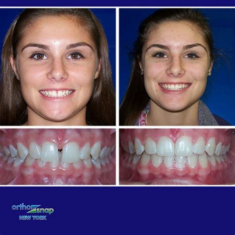 Orthosnap Is An Easy To Use And Affordable Alternative To Braces As