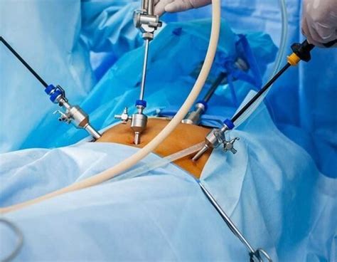 Laparoscopic Myomectomy With The Gyne Clinic Contact Us