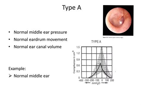 Tympanometry | PPT