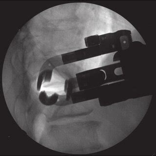 Intraoperative Fluoroscopic Image Showing Positioning Of The Retractor