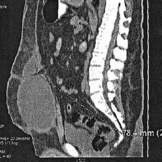 Multi Slice Computed Tomography Of The Abdomen Sagittal Plane Liquid