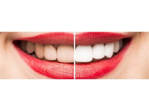 The Perfect Smile - Imperfection is Key | Beverly Hills Dentists