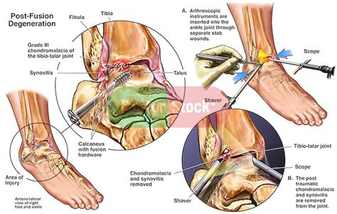 Additional Deterioration Of The Ankle With Arthroscopic Debridement Doctor Stock