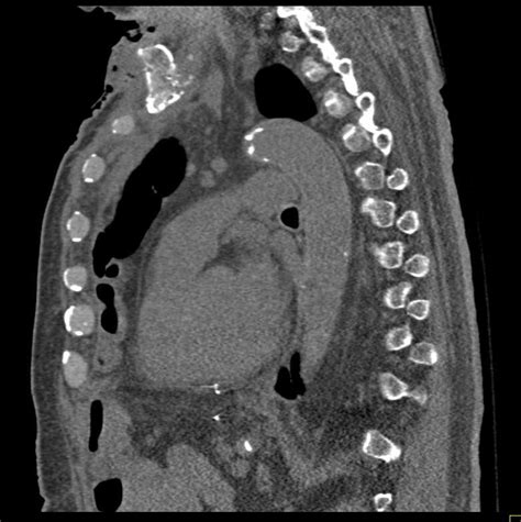 Osteomyelitis Sternum With Abscess Chest Case Studies Ctisus Ct