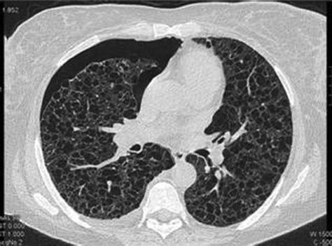 Computed Tomography Shows Diffuse Cystic Change Consistent With