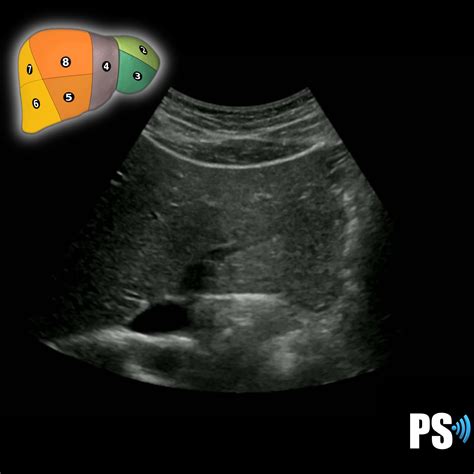 Couinaud’s Liver Segments – Sonographic Tendencies