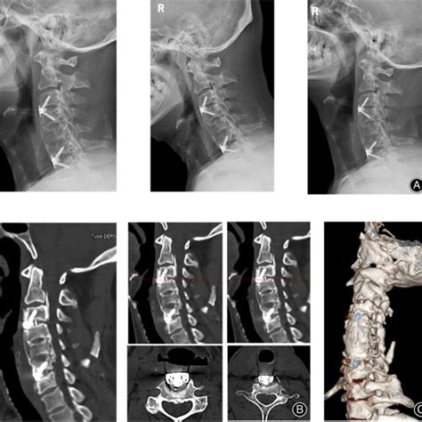 3 Monthes Fellow Up Lateral Flexion Extension X Ray Of Cervical Spine Download Scientific