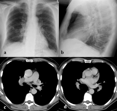 frontal   lateral  chest  ray show  bilateral hilar