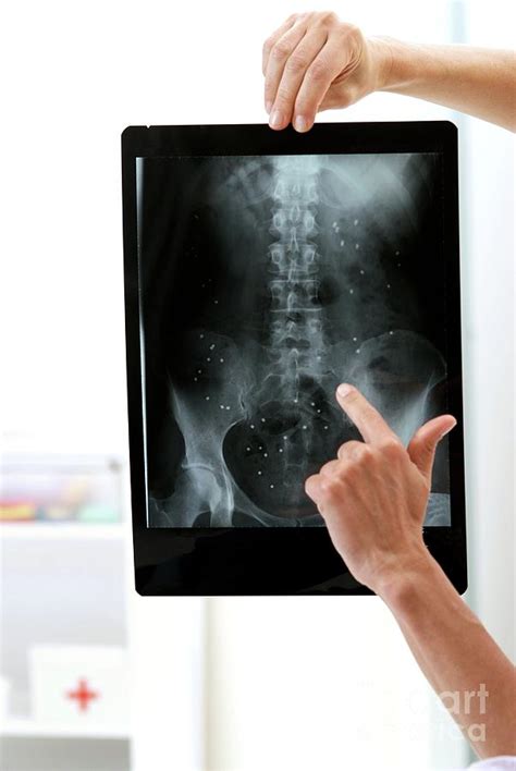 X-ray Diagnosis Photograph by Lea Paterson/science Photo Library | Pixels