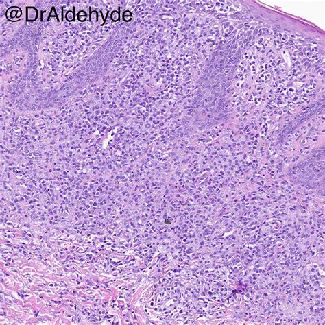 Mycosis Fungoides Prognosis