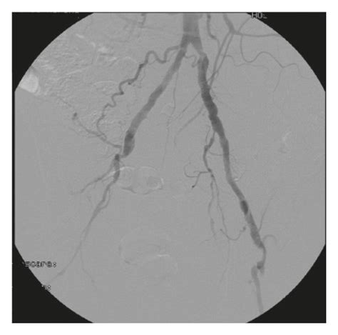 A Important Aortoiliac Calcification B Arteriography Showing