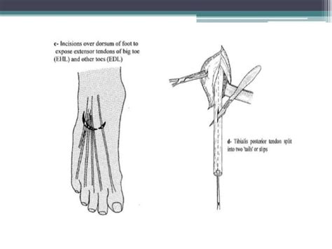 Reconstructive surgery in Leprosy