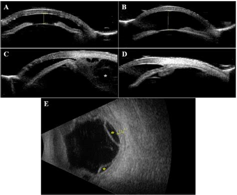 Ultrasound Biomicroscopy Ubm And B Scan Ultrasound Of The Right Eye